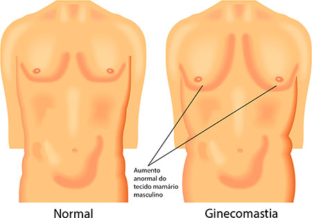 causas ginecomastia masculina