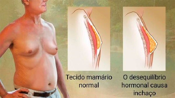 ginecomastia masculina sintomas