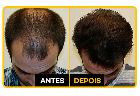 HairLossBlocker antes e depois