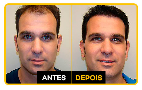 HairLossBlocker antes e depois